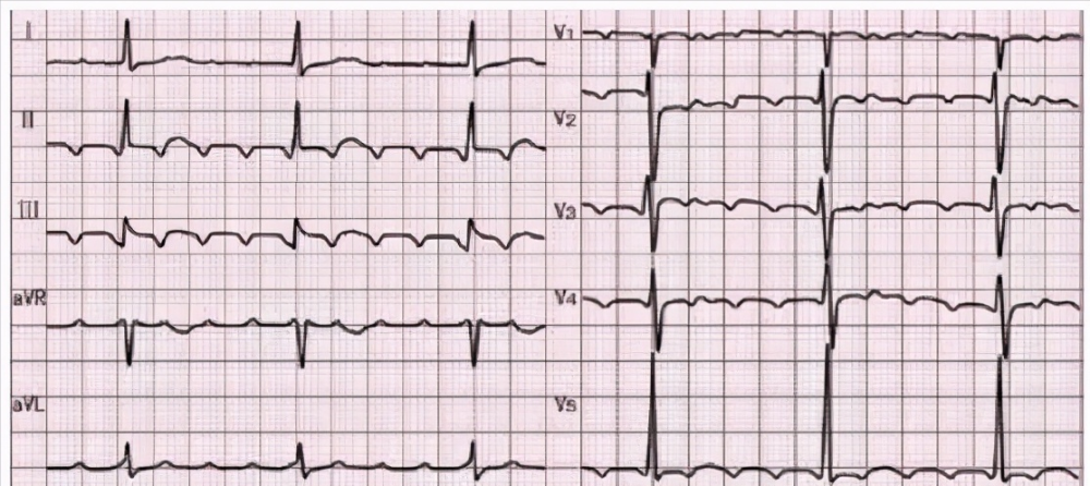 图4 酷似心房扑动的房性心动过速注:心房波频率2
