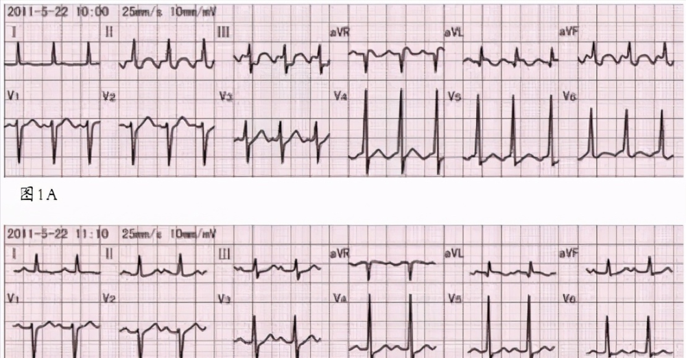 如何利用心电图"揪出"心房扑动,做出诊断与鉴别诊断
