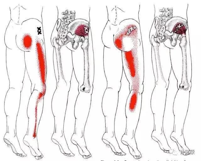 第二种腰间盘突出部位却不是腰椎