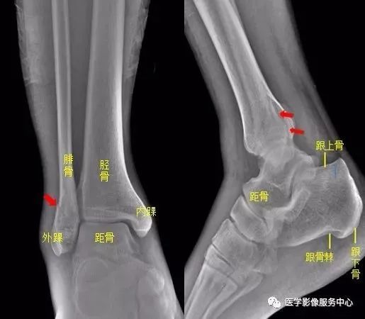 11足部右足斜位示 右侧跟骨前部见骨折透亮线,右跟骨前部骨折.