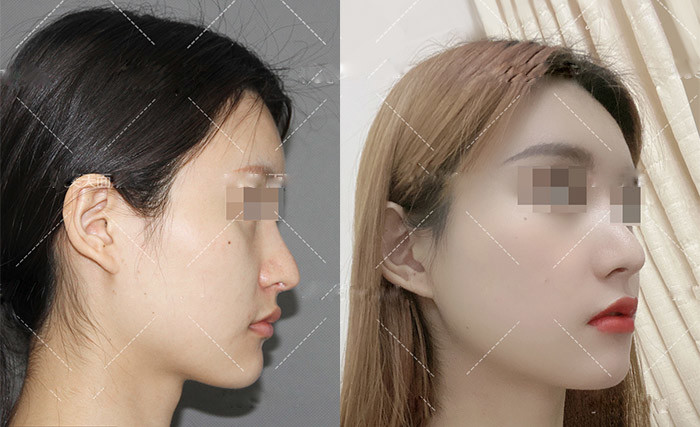 下颌线决定好看程度,你的侧脸能打几分?