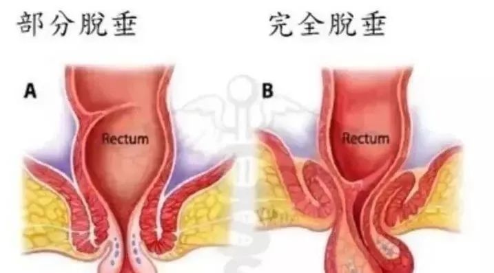 直肠脱垂的治疗依年龄,严重程度的不同而不同,主要是消除直肠脱垂的