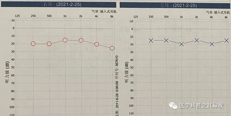 纯音听阈检查