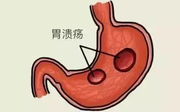 胃疼怎么缓解? 1,勿平躺