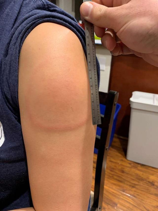 hypersensitivity」,它指的是接种新冠疫苗一周左右在接种部位出现的