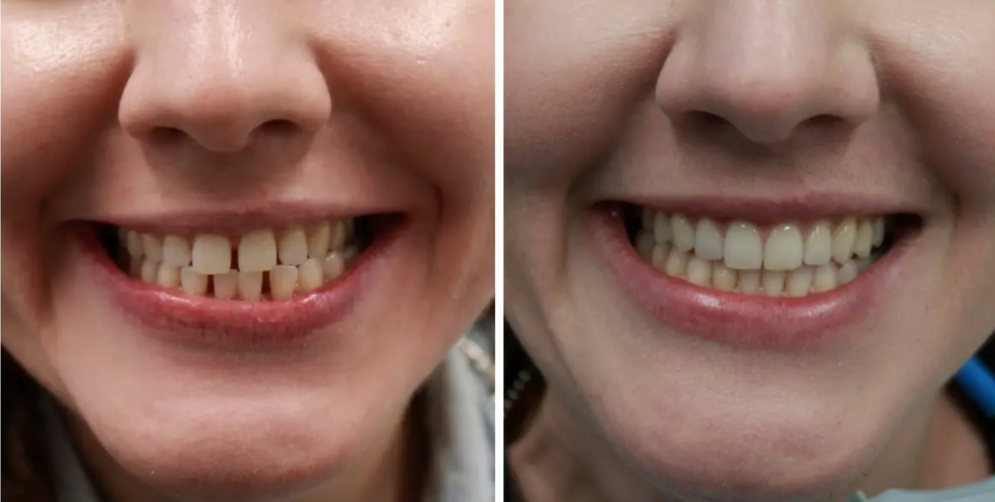 这种情况大多是因为多生牙,比较常见的是长在门牙之间的牙.