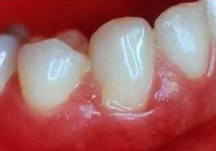 塞在牙缝的食物残渣不断挤压牙龈,牙菌斑在牙龈边缘不断刺激,使牙龈