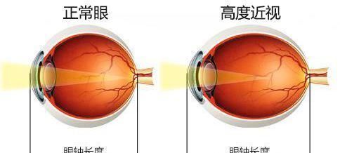 近视的危害,有哪些恢复视力的好方法