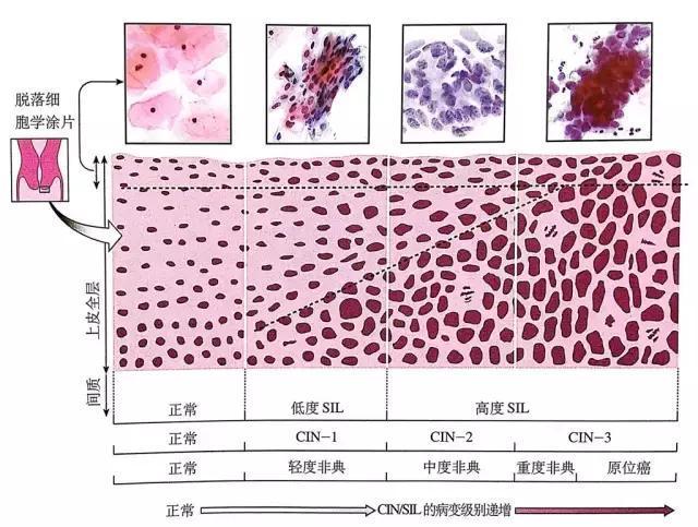 是一组病变的统称,包括宫颈不典型增生和原位癌