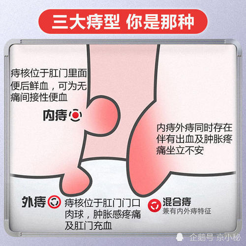 如何区分内痔,外痔,混合痔?