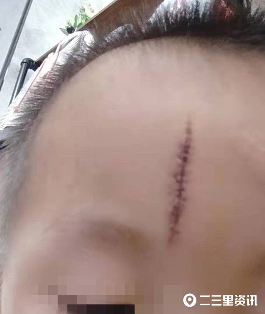 她的儿子2019年在渭滨区博艺幼儿园头部被磕伤缝针,近两年幼儿园都没