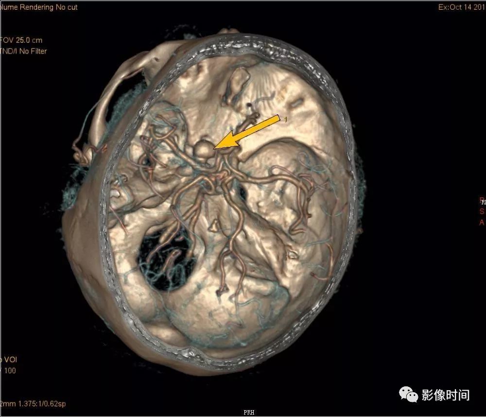 8 个病例带您一起复习颅内动脉瘤这些知识