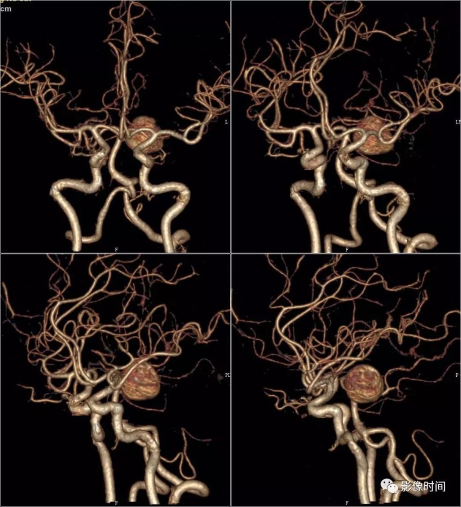 mra: 造影剂填充不均匀 cta 示左侧大脑后动脉 p1 段局限性瘤样扩张
