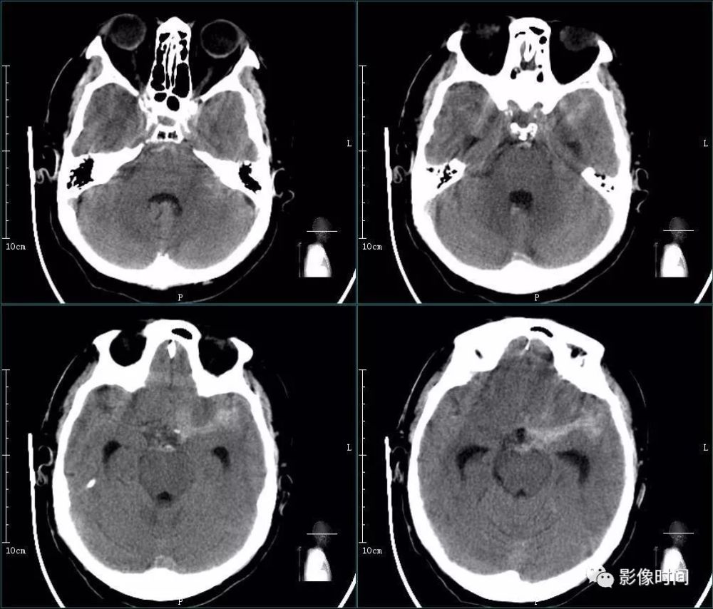 环池,鞍上池及部分脑沟密度增高,诊断为蛛网膜下腔出血; cta:vr,mip