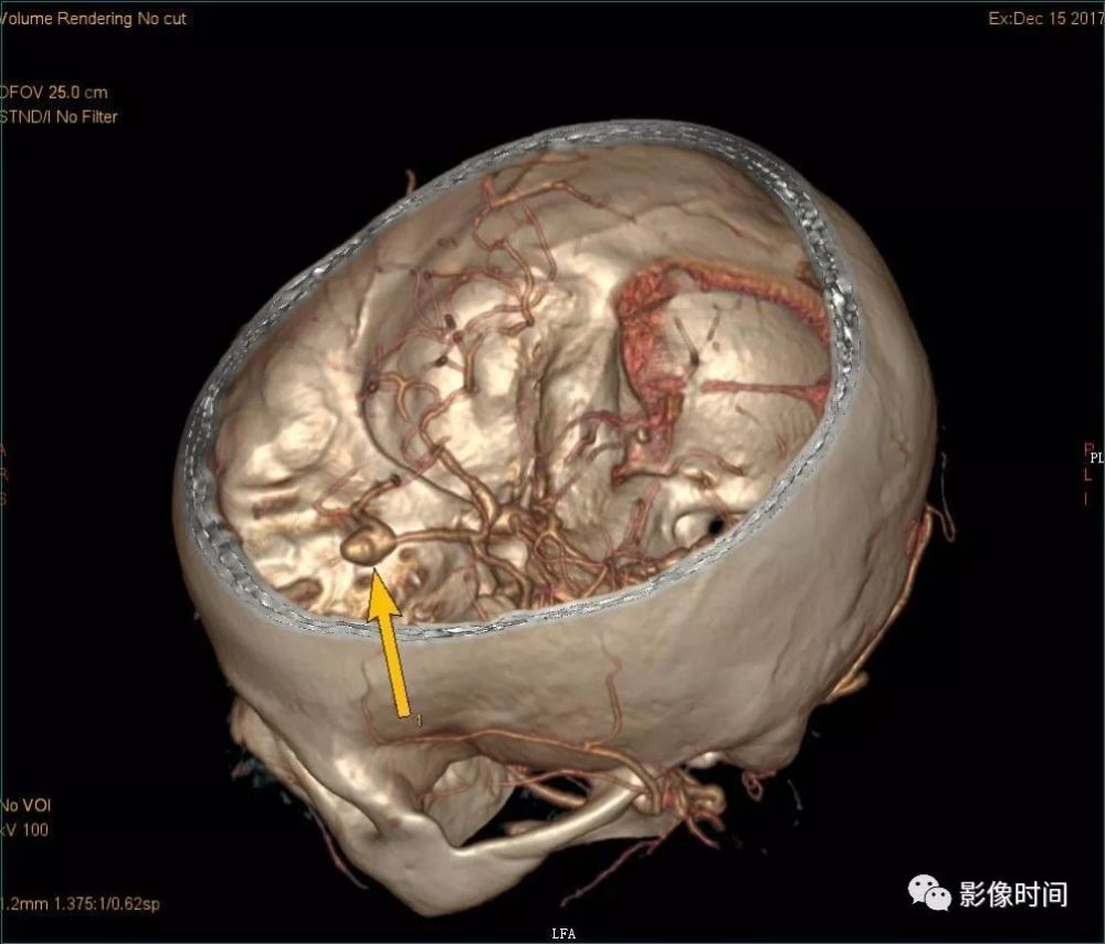 cta 示:大脑前动脉动脉瘤 case  :患者女,75 岁,头突发头痛呕吐