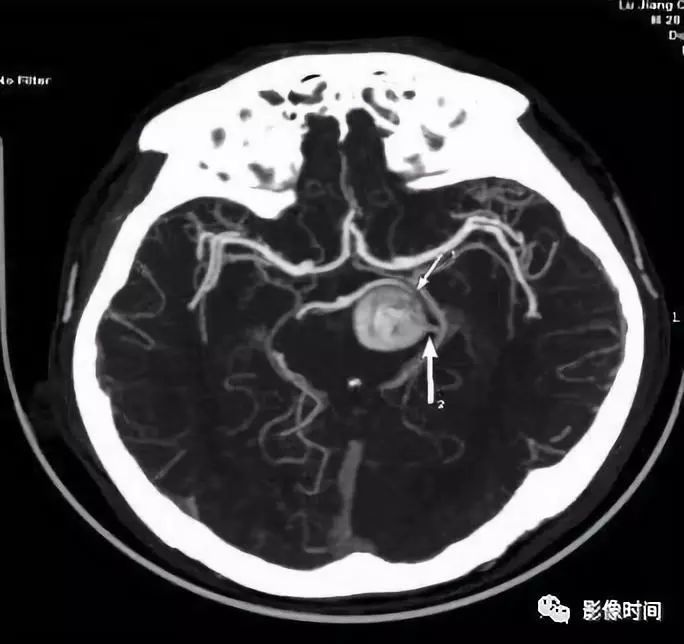 8 个病例带您一起复习颅内动脉瘤这些知识