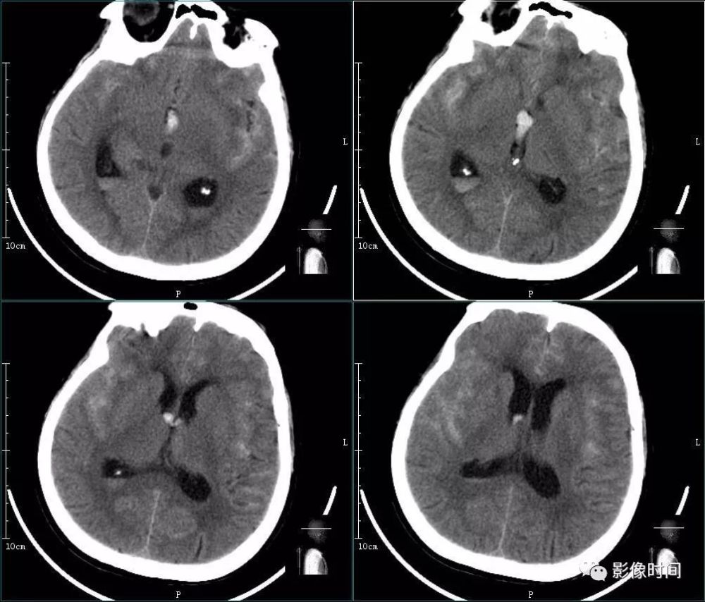 女,48 岁,突发意识障碍 2 小时入院ct 平扫:双侧外侧裂池,大脑纵裂池