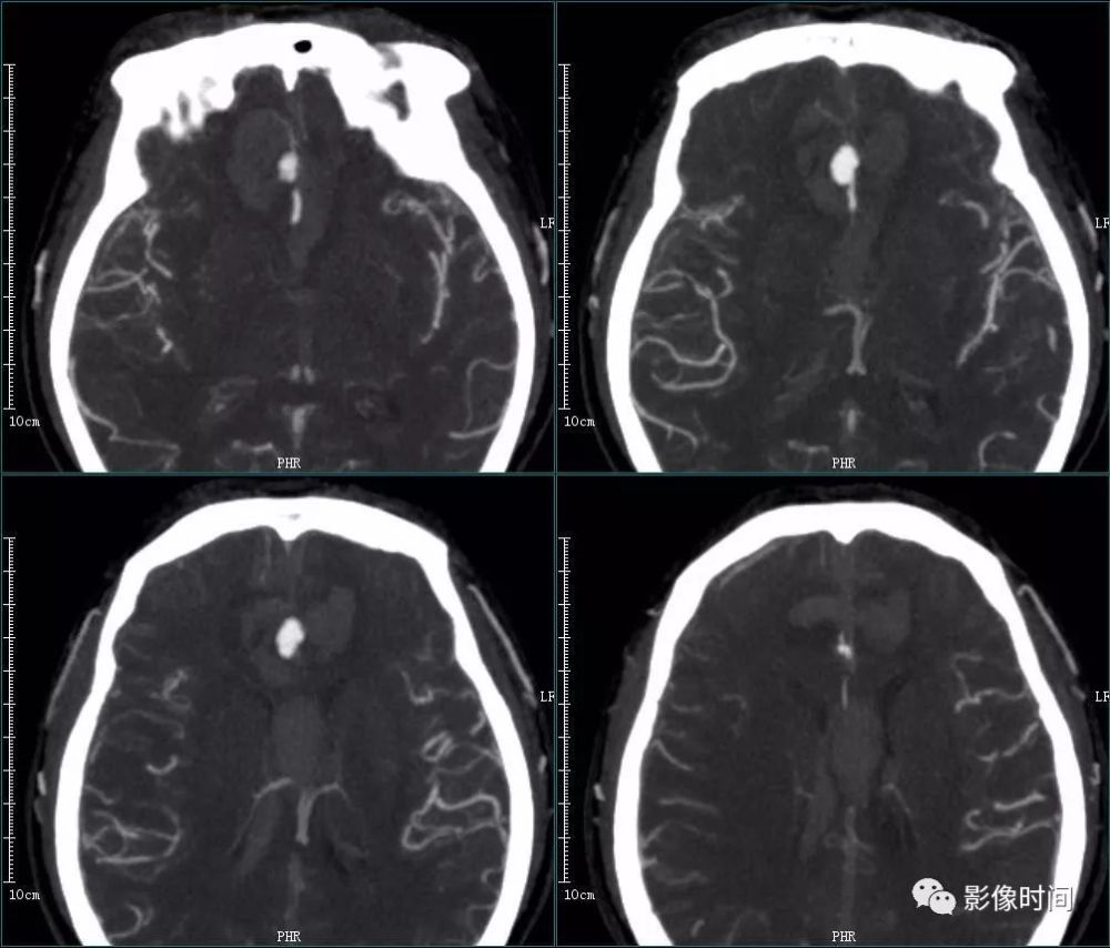 8 个病例带您一起复习颅内动脉瘤这些知识
