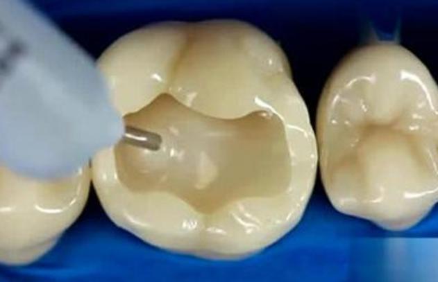 补牙时,为啥牙医会把牙洞越磨越大?为啥补完牙,牙还是