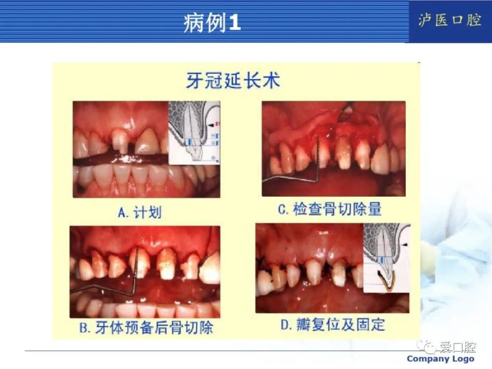 牙医必备技能"牙冠延长术"一定要掌握