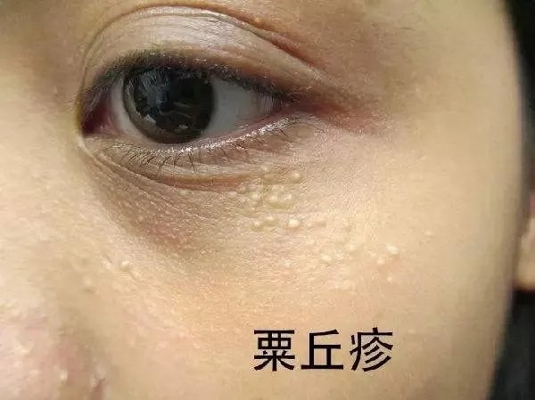 汗管瘤与栗丘疹和脂肪粒有什么区别?