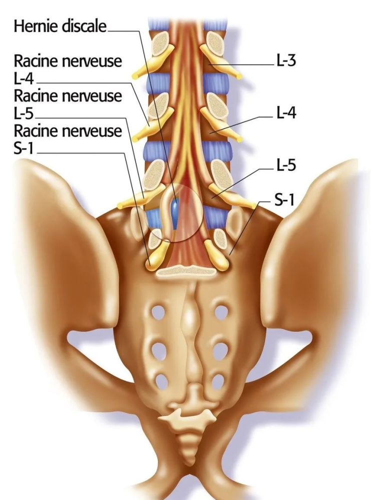 先天性肿瘤压迫等原因导致脊髓牵拉,圆锥位置下降,造成脊髓及马尾神经