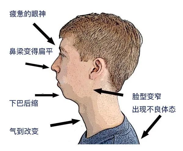 还在张嘴呼吸?你就是这么变丑的!
