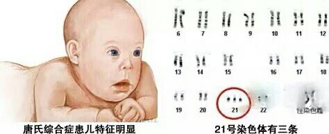 "唐氏综合征"患儿妈妈的亲口讲述:背负沉重的爱艰难前行