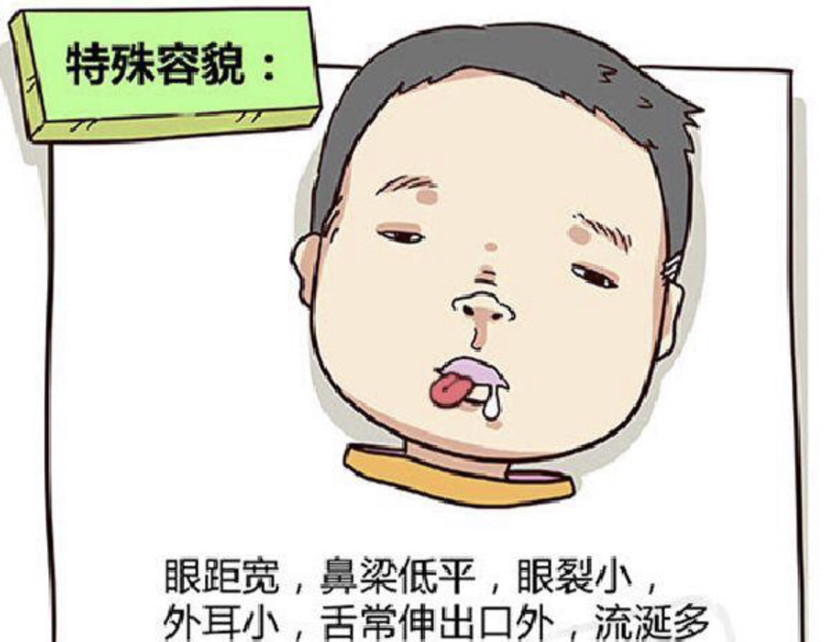 "唐氏综合征"患儿妈妈的亲口讲述:背负沉重的爱艰难前行