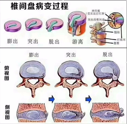 而腰椎间盘膨出,突出,脱出可以理解成椎间盘病变的不同程度.