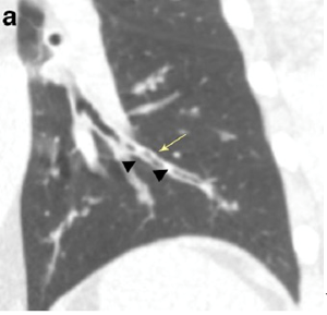 慢性支气管炎患者的胸片:右肺门附近双轨征(箭头)[3,4]仔细观察胸片时