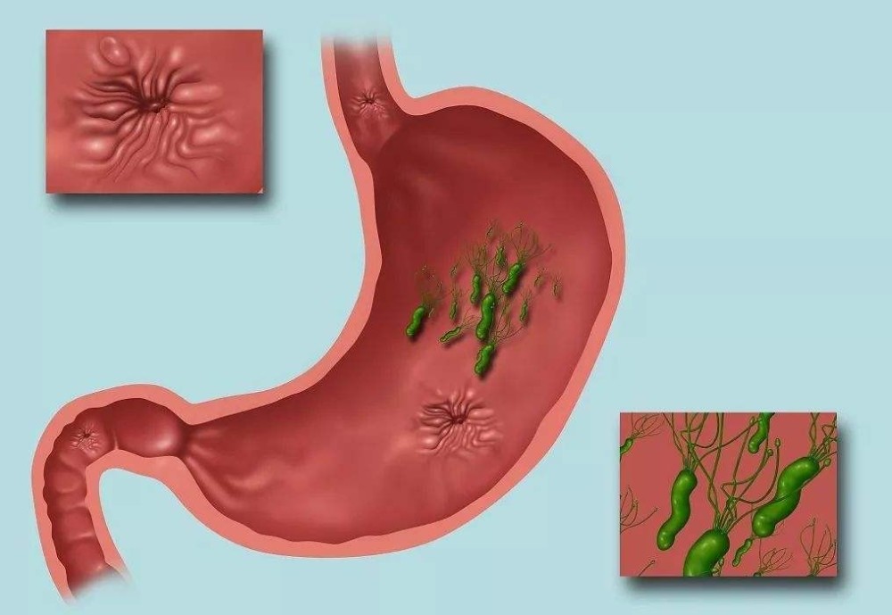 27岁空姐备孕半年,幽门杆菌超标,医生:胃里长满"鸡皮疙瘩"