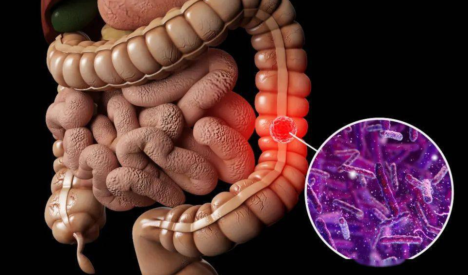 肠癌早期不明显?注意大便3个表现,医生摇头:再拖下去就晚了