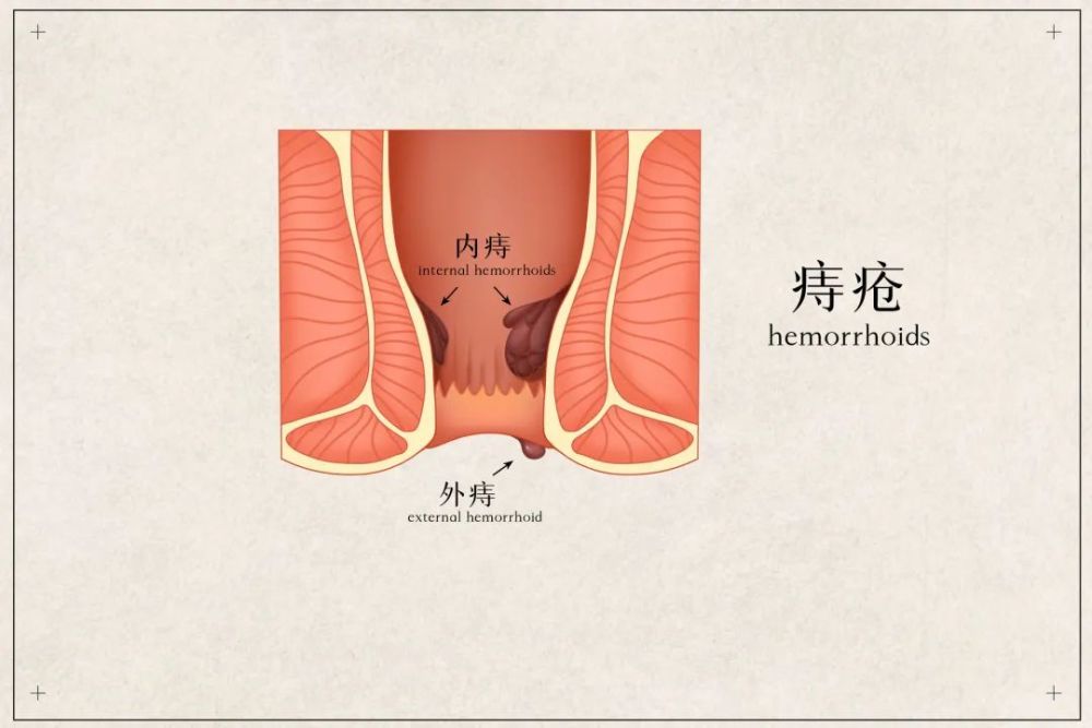 痔疮,一般藏在菊花附近. 这跟人类直立行走有直接关系.