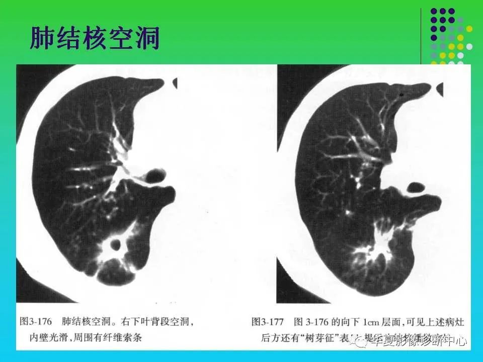 肺空洞性病变和囊性病变的ct诊断