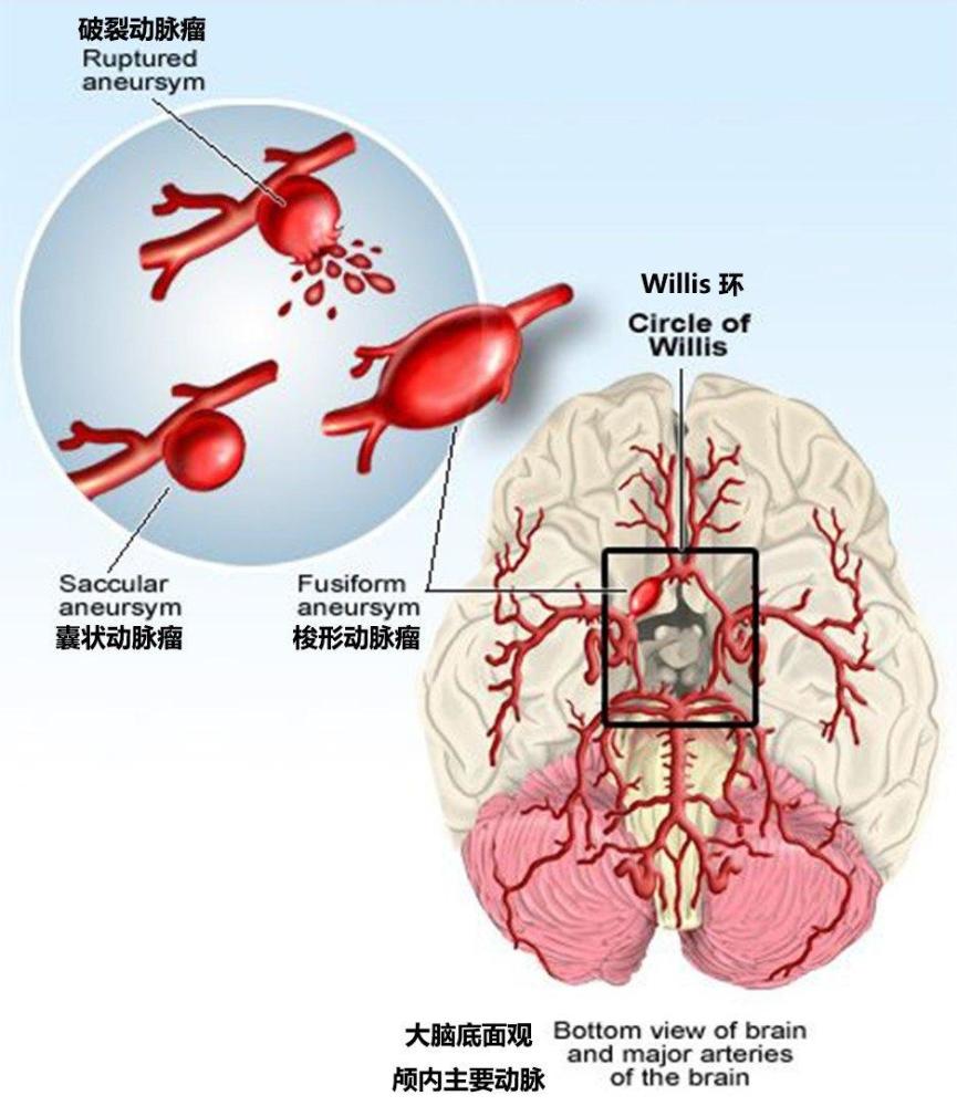 2.2%的患者是脑血管畸形