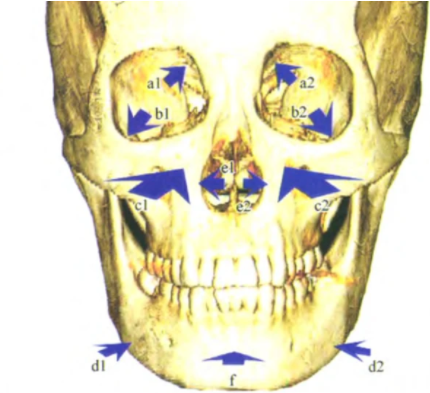 鼻唇沟加深——面中部骨骼在衰老 有相关研究表明,由于上颌骨的面积