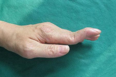 类风湿病友该如何预防手指畸形?