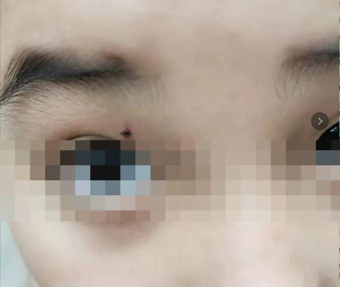 妈妈说自己本来在正常上班,突然接到学校电话说孩子被同学用铅笔插伤