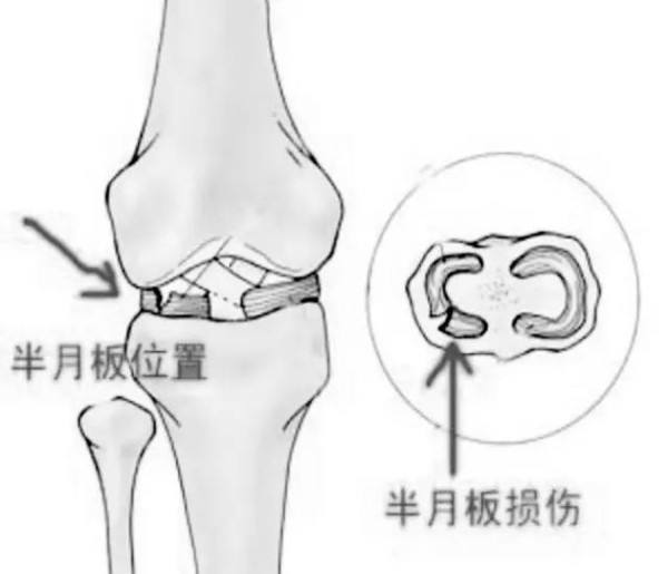 半月板撕裂怎么治疗最好