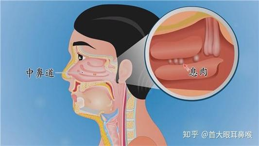 广东崇爱康复医院医师教你如何在发现早期鼻息肉症状