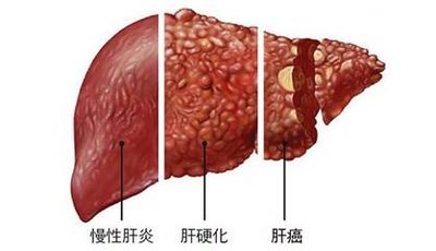 原发性肝癌