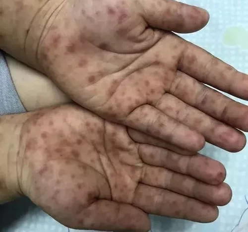 突发新型手足口病,发病率高,极易传染,家长注意预防!