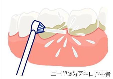 洗牙出血,是洁牙师的错吗?