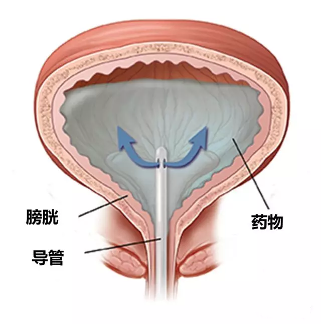 所以需要术后进行辅助治疗,比如膀胱灌注