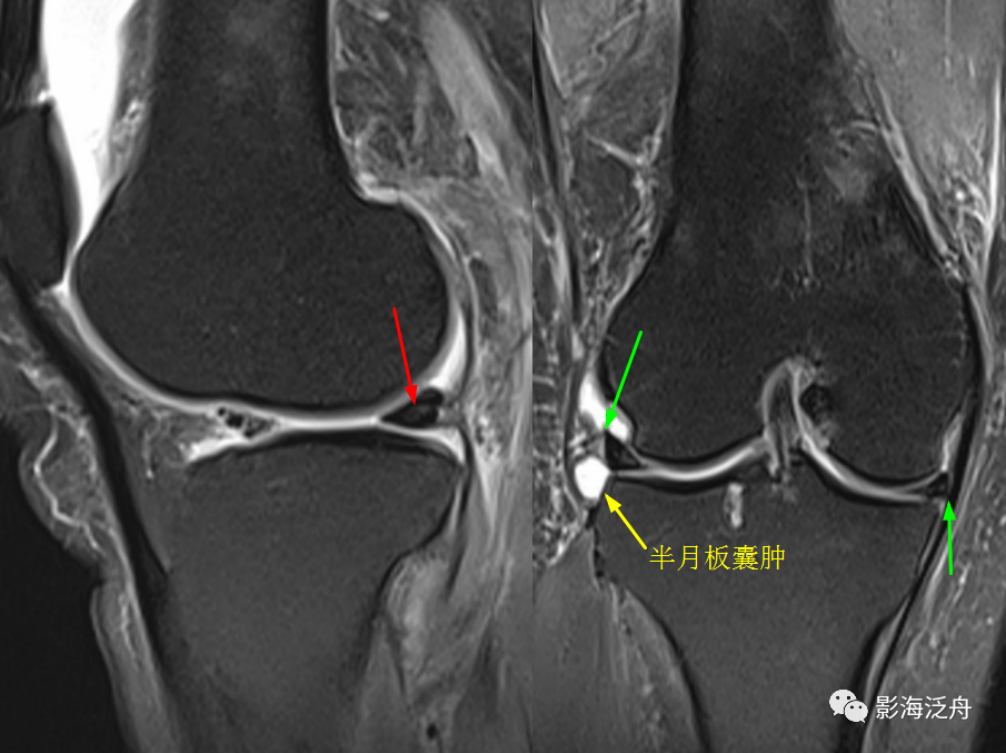 面对半月板损伤,从此不再迷茫
