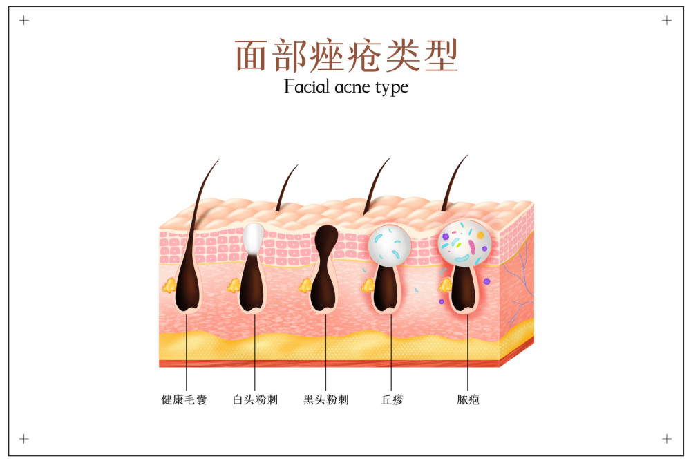火针——治疗痤疮的经验分享,这5个注意事项一定要做好