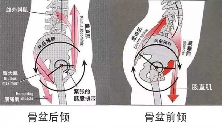 建议:骨盆后倾的患者,要加强腹肌和髂腰肌力量,可进行适当仰卧起坐,直