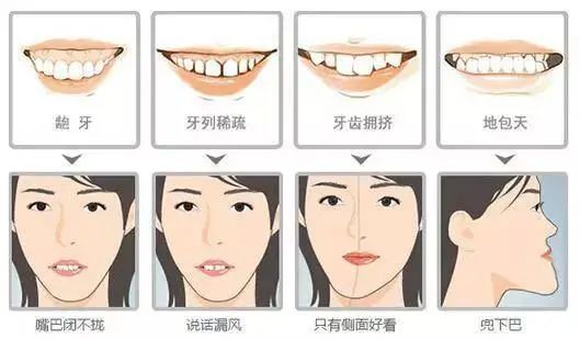 牙齿畸形对脸型的影响△ 不良影响2:影响发音