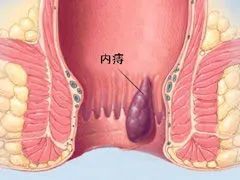 合肥瑞金肛肠医院:屁股痛就是上火?很有可能是这些问题